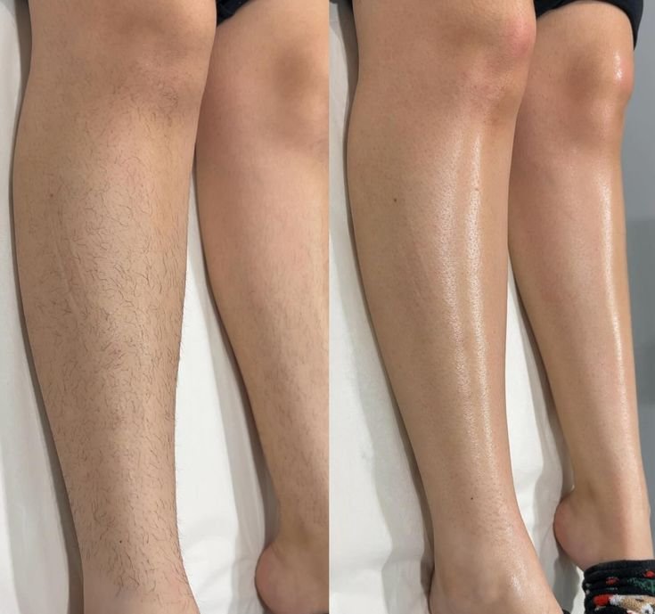 Resultado de depilação pernas — antes e depois