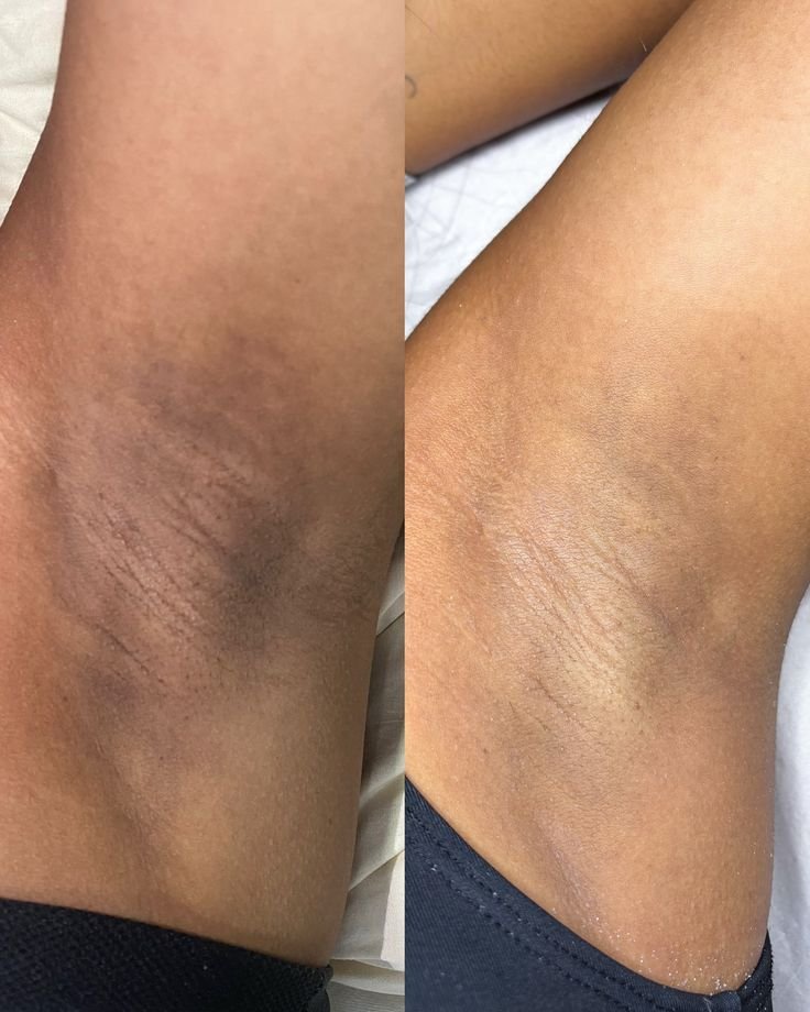 Resultado de depilação — antes e depois
