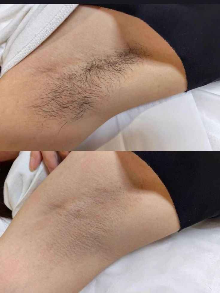Resultado de depilação axila — antes e depois